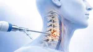 Cervical Endoscopic Techniques
